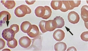 The slide shows blood cells contaminated by lead.